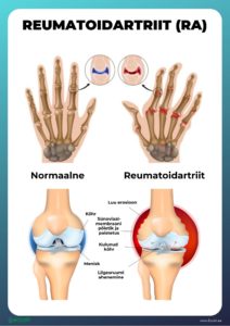 tuhi kaed ja valus liigesed artriit ja artroosi sormed