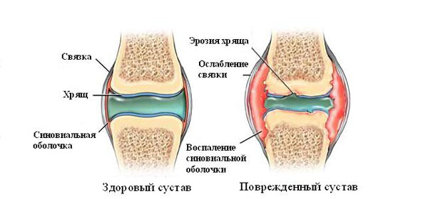 mis vahe on artriidi vahel liigeste artroosist diclofenaki liigeste poletik