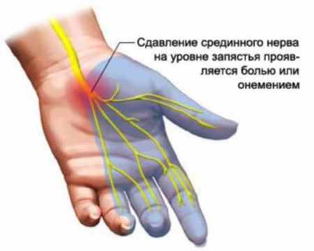 pulseeriv valu sormede liigestes olaliigese ravi parast kaes langemist