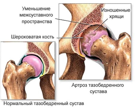 kuunarnuki liigese ravi artriit agar-ravi liigesi