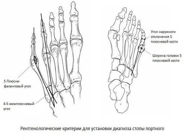mis on vaikeste jala liigeste artroosi