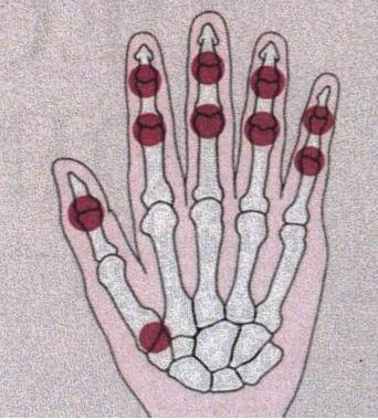 hurt sormede phalangesi liigesed artroosi ravis aitab mind