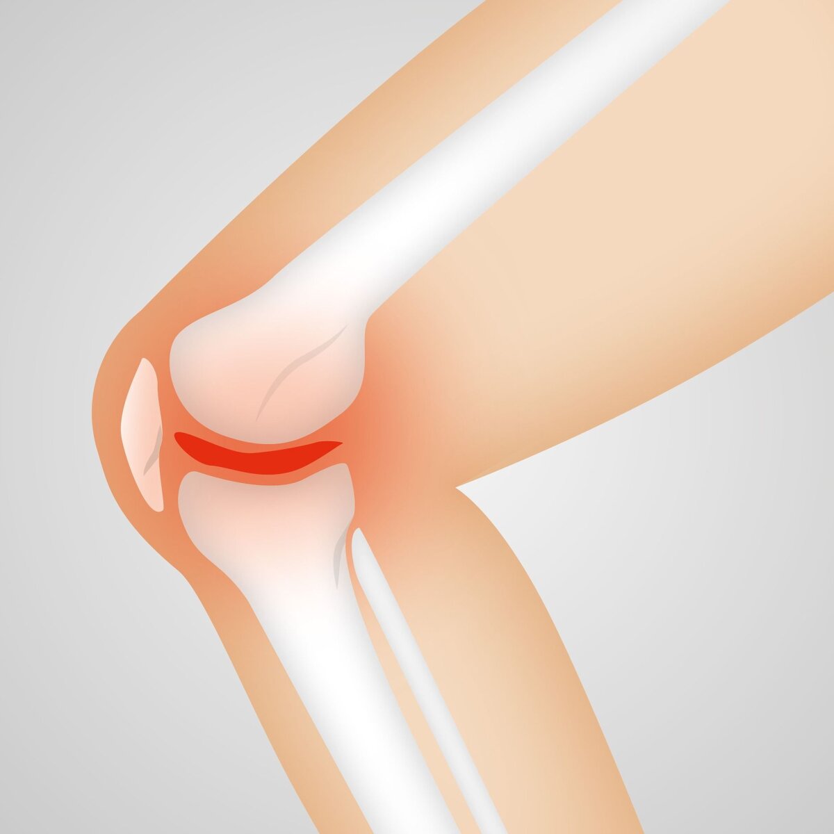 arthroosi jala pohjused ja ravi salv ola liigese artroosist