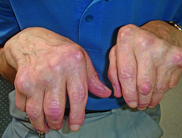 sormede ja jala liigeste artriit