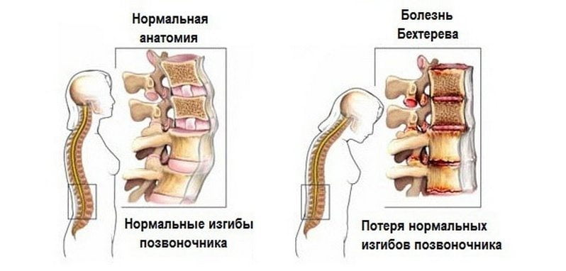 back-ravi liigeste poletik