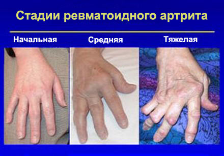 arthrisise kiirguse ravi