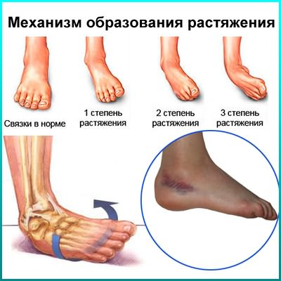 kreeni jalgade liigeste poletik liigeste ravi nizhny n