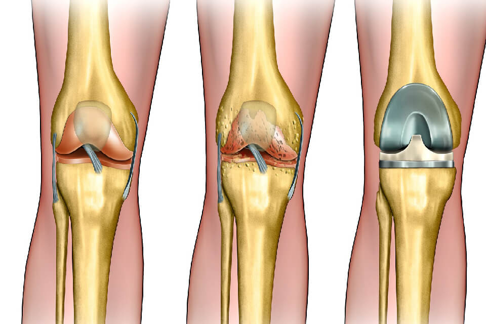 uhise valu toidu pohjus arthroosi jalgade ravi koos kase lehtedega