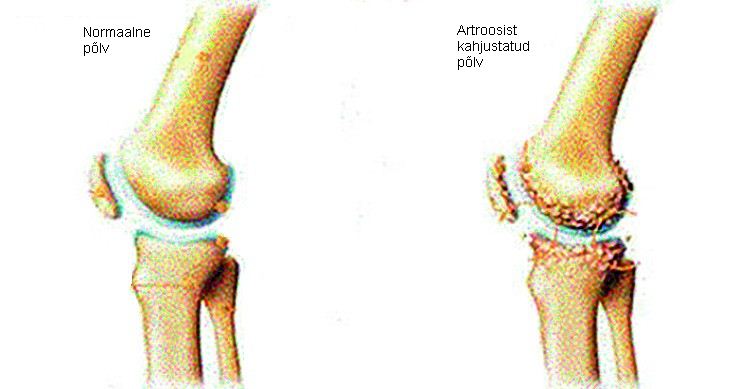 liigeste artroos on hupoterioosi liigesed haiget