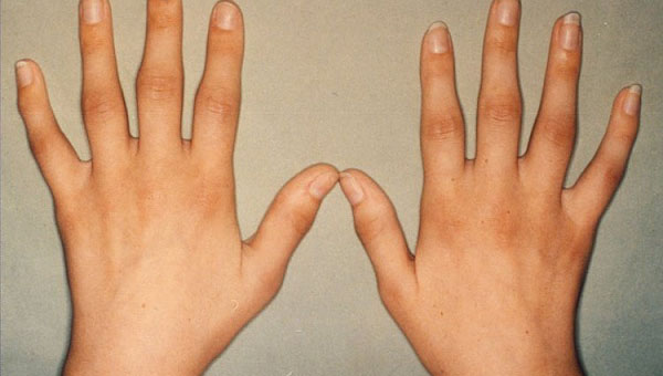 thumb traumaatiline artroos