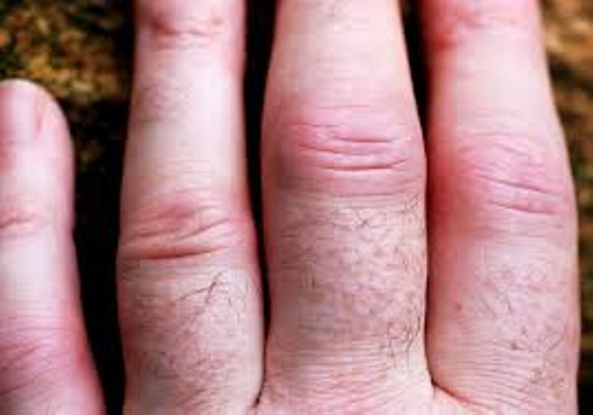 sormede artriidi luud