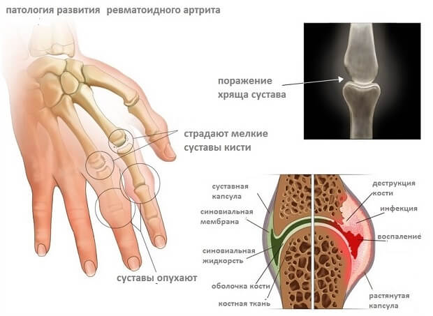 valus vasaku kae keskmise sorme liigesed 2 kraadi ravi artroos
