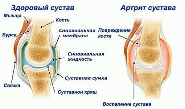 liigeste artroos taiskasvanutel