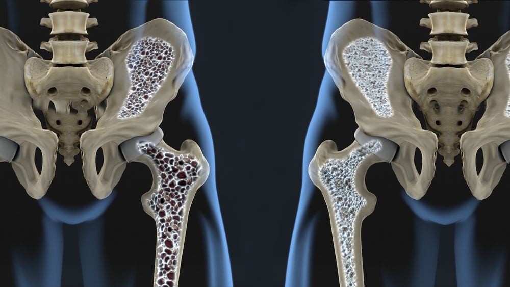 liikumine liigeste ravi osteoartriit sustav ravi