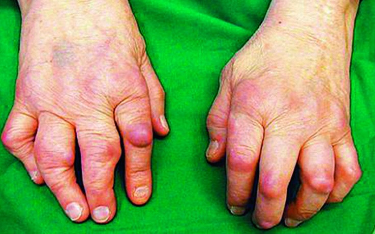 sormede ja jala liigeste artriit