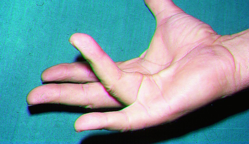 mida artriit sormedega valja naeb