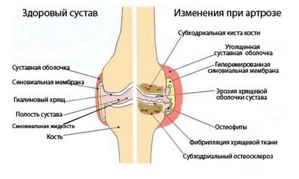 rahvaviiside artroosi sormede raviks dislokatsioon kuunarnuki liigese bundles ravi