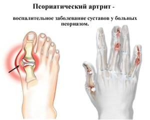 2 kraadi ravi artroos kuidas maarata artroosi ravi