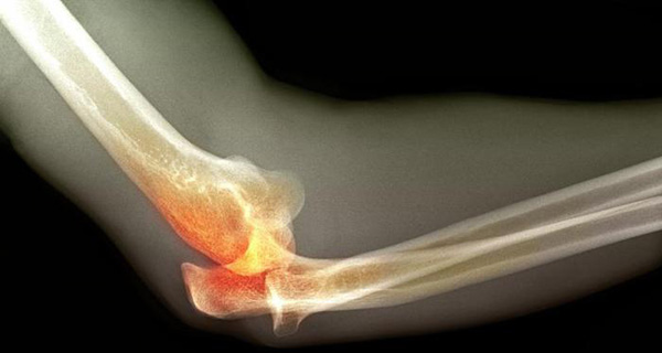 esimese kraadi ravi artroos kasi sorme liite poletik parast vigastuse ravi