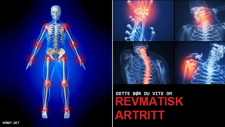 kaeulatuste artroos pohjustab ja ravi