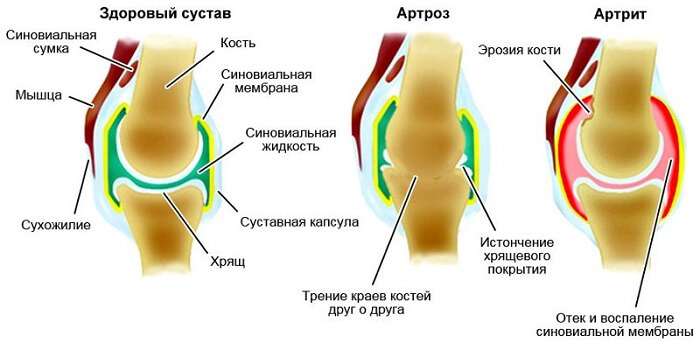 liigeste ennetamise artroos kuidas eemaldada polve artroosi poletik