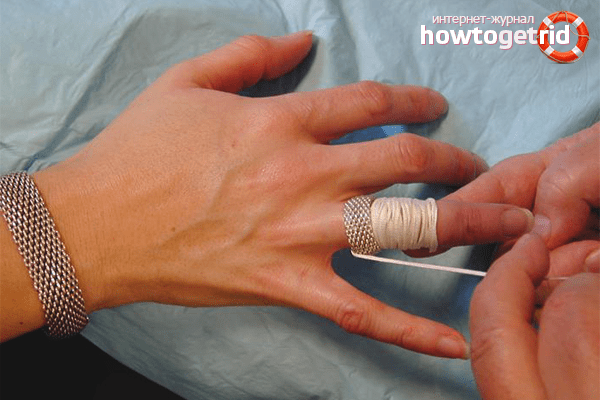 kuidas eemaldada turse sormest valu liigeste reumatism