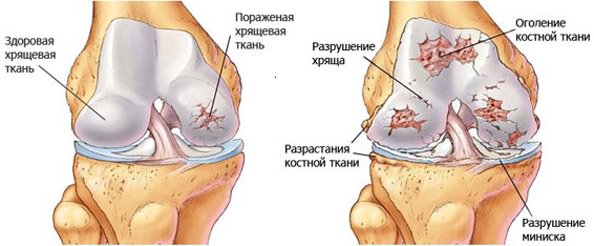 kuidas ravida artroosi jalgu
