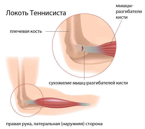 kuunarvarre liigeste haigused jala liigeste poletik