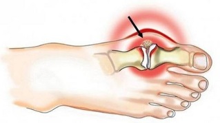 liigeste nakkushaiguste tunnused kuidas ravida artroosi jalgu