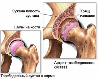 osteoartriit sustav ravi punane laigud sormede kate ja valus liigesed