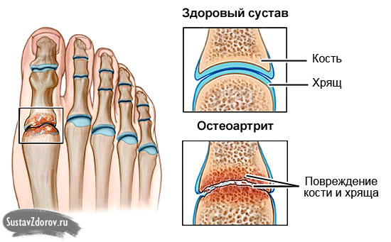 artriit brush hands reviews salvi piss valu ajal osteokondroos