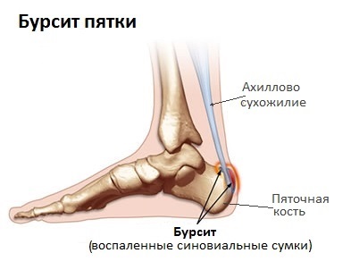 artroosi ravi kui liigesed elavad jalad