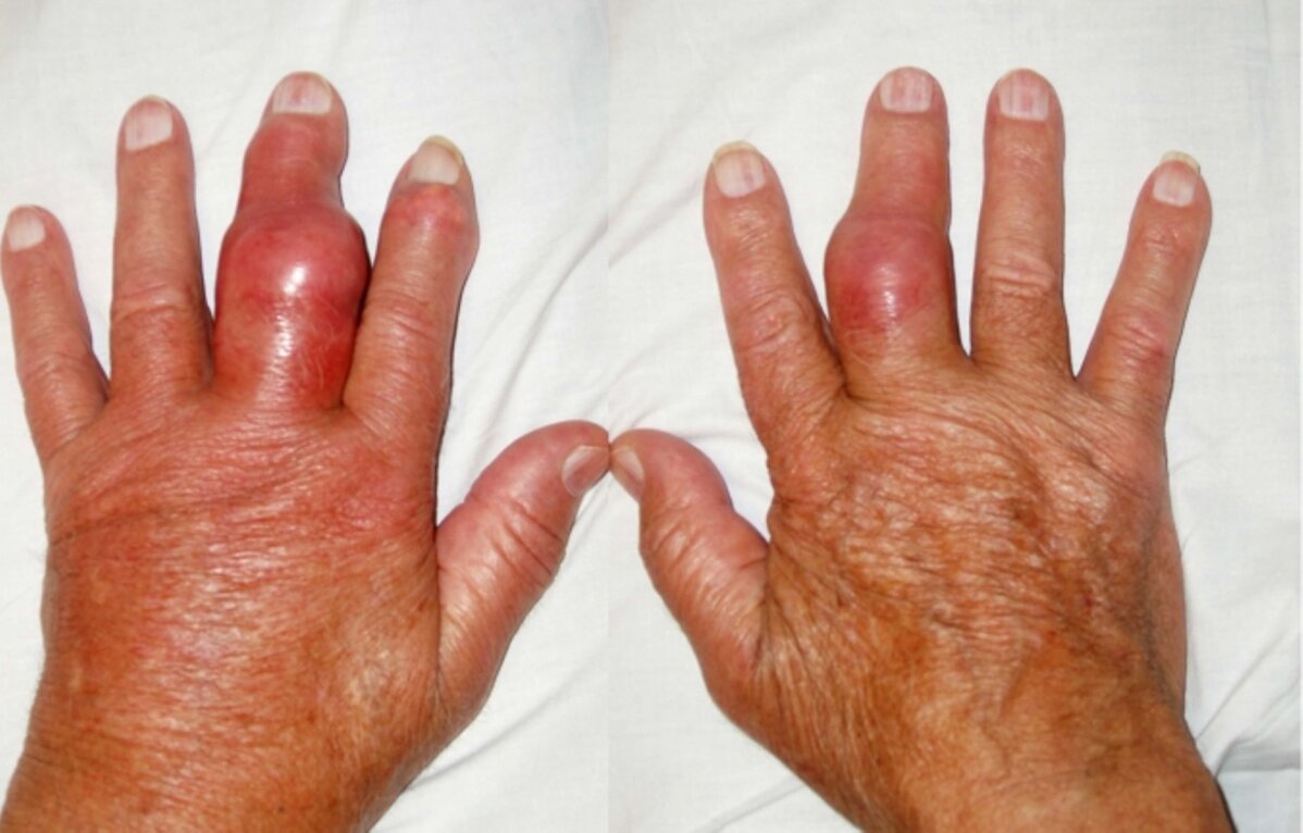 tugev valu suurte sormede liigestes valu kuunarnuki liigese pohjustes kui ravida