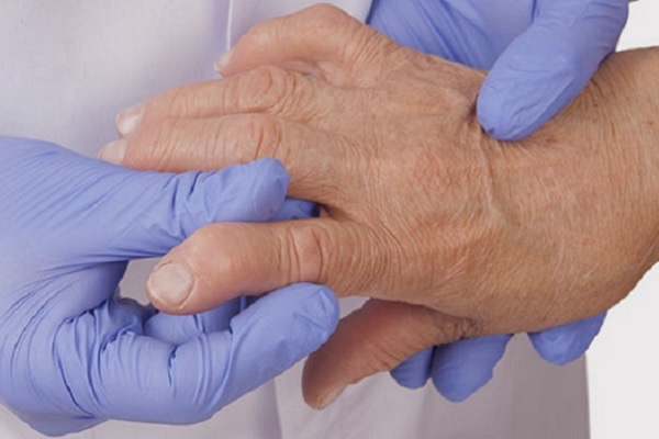 tugev valu suurte sormede liigestes artrosi liigesed kaed sormed