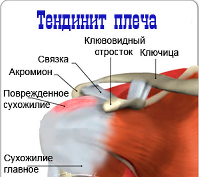 valus olaliigese ja lihaseid inmulaadi liigeste artroos