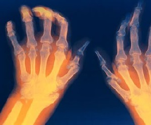 artriit ja artroos ja nende ravi