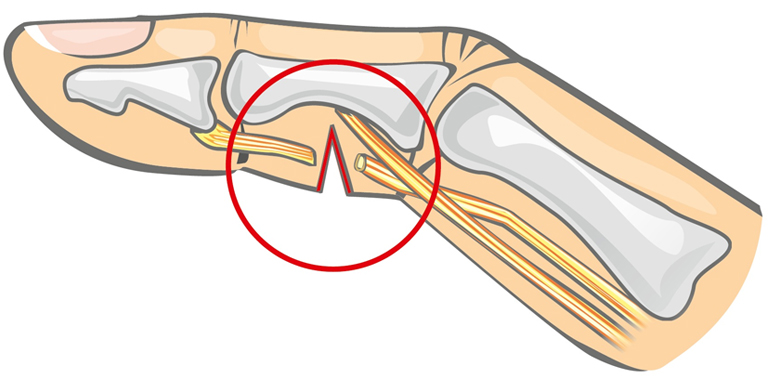 kaed haiget artriidi parema kae sormede valus liigesed