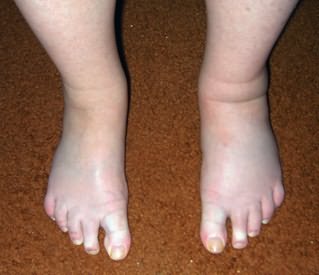 valu jala liigestega coco artroosi ravi