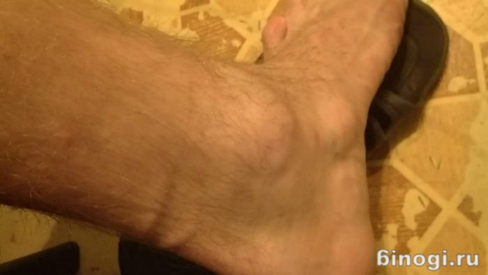 valu jala jalgade pohjuste ja ravi jalamil liigeste minvory ravi