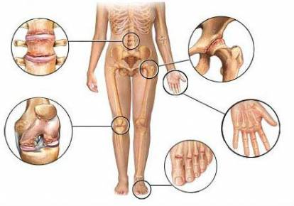vahendid liigeste turse eemaldamiseks esialgne artroosi ravi