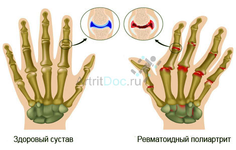parast tramaatilist sorme artriit