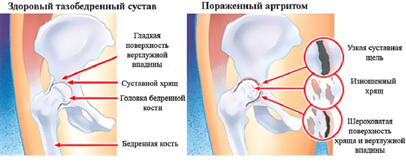 pohjus artroosi koigi liigeste meditsiinilise sapi liigeste haigustes