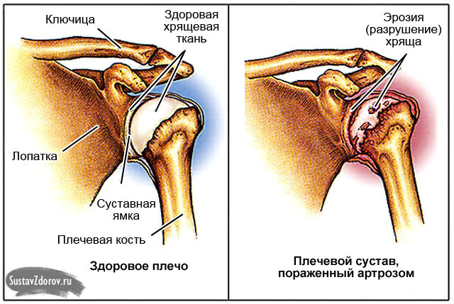 vasaku ola liigese valu pohjused distaalsed artriidi sormed