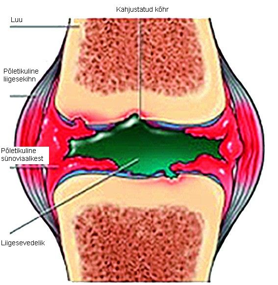 elbow liigese 1 kraadi artriit traumaatilise uhise valujargne ravi