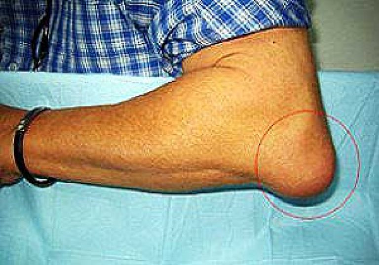 artriit kuunarnuki liigese ravi kodus salv sorme sormede valus