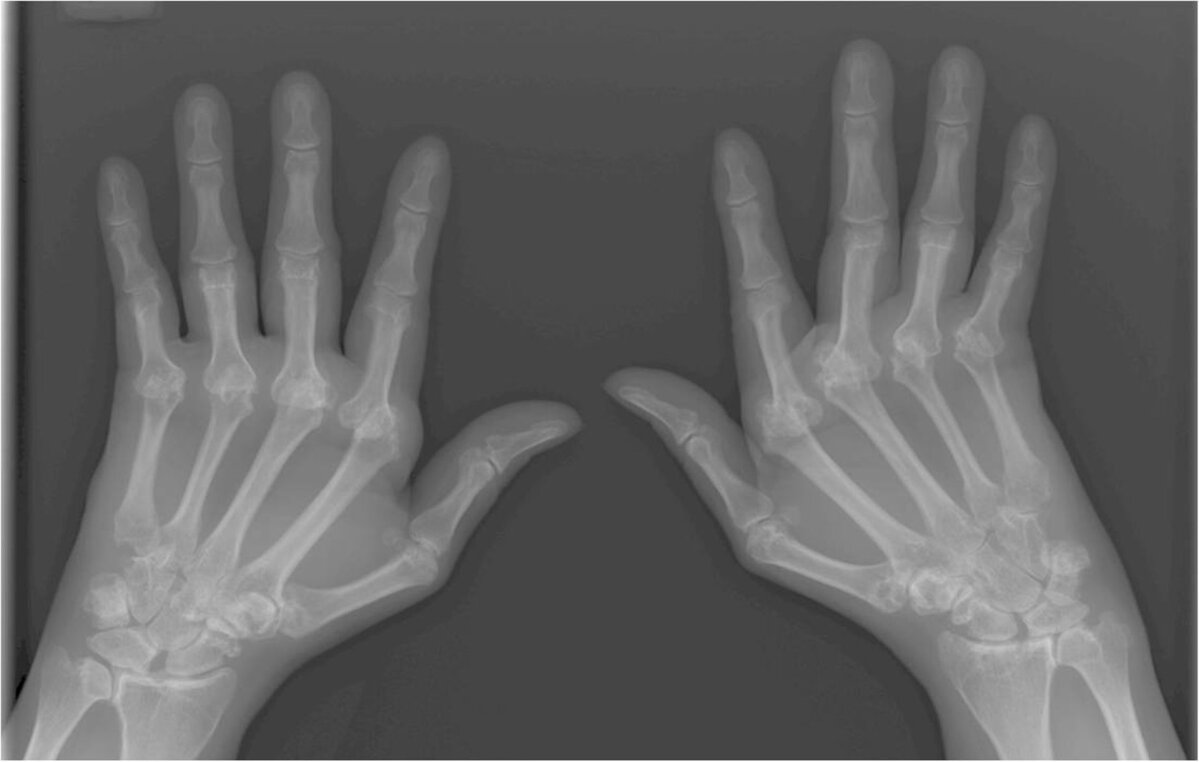 millised on kate sormede liigeste haigused
