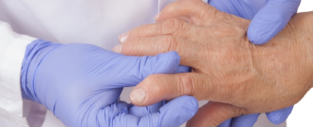 ravi maitsetaimede arthroosi sustav age artriidi liigesed