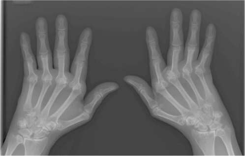 kate sormede liigeste venitamise ravi kasi valu ja kaed