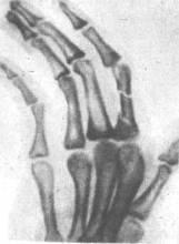keskmise sorme artroos valu uhise poidla jalgsi kui ravida