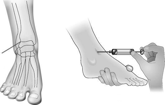 kuidas eemaldada poletiku kate ja jalgade liigestes narvid liigeste ravi